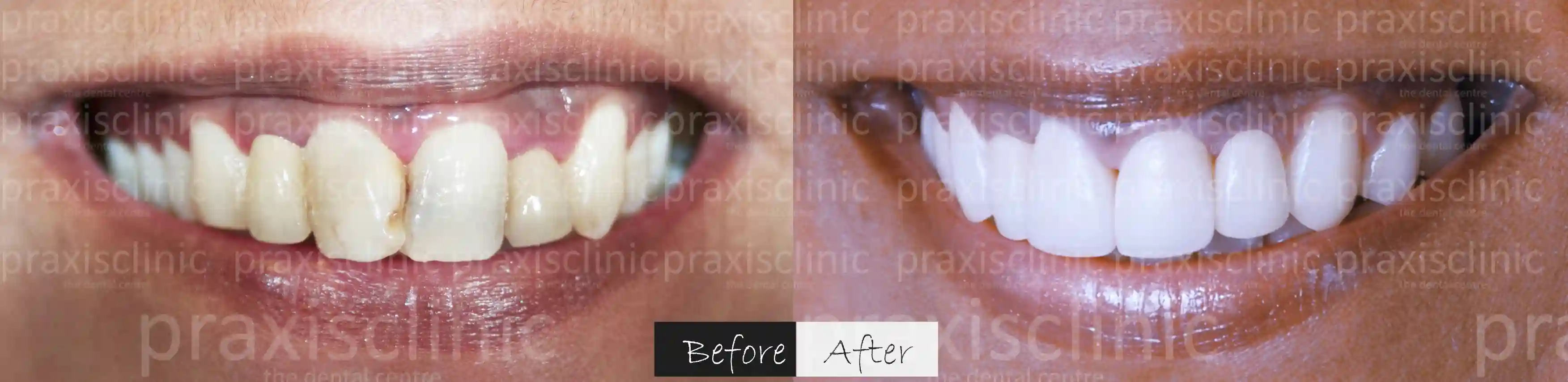 Before and After results of Cosmetic Dental Makeover at Praxis, best dental clinic in Mumbai